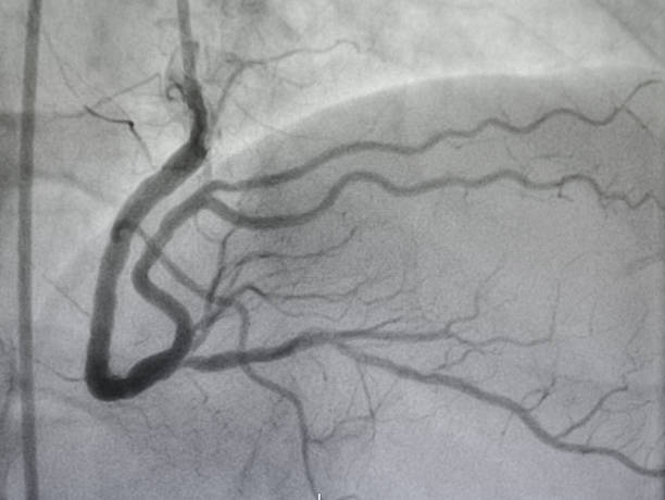 Angiography And Angioplasty in Navi Mumbai